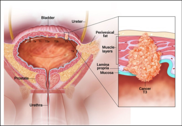 bladder cancer